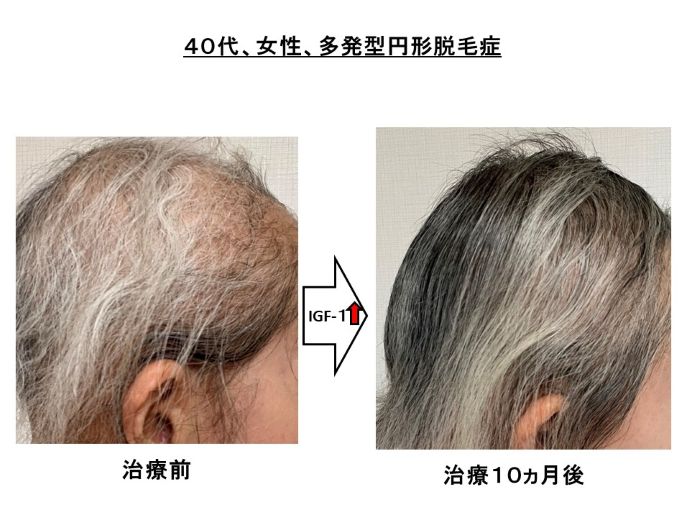 円形脱毛症　病院